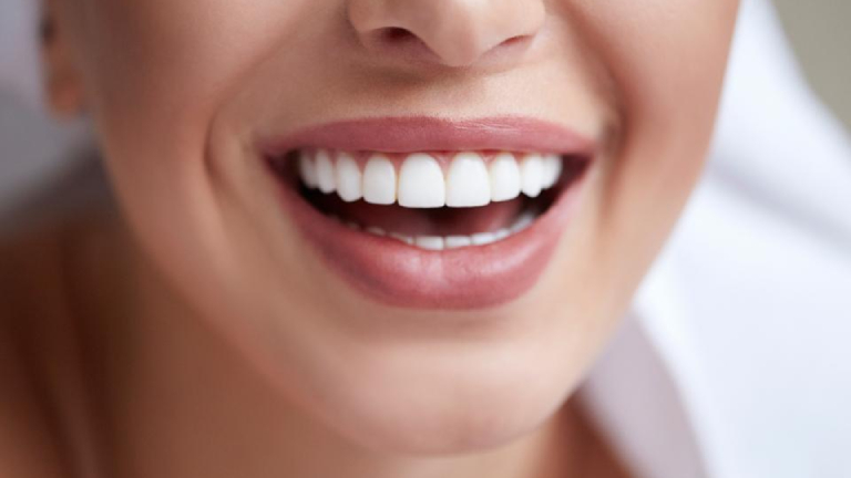 Porcelain Veneers