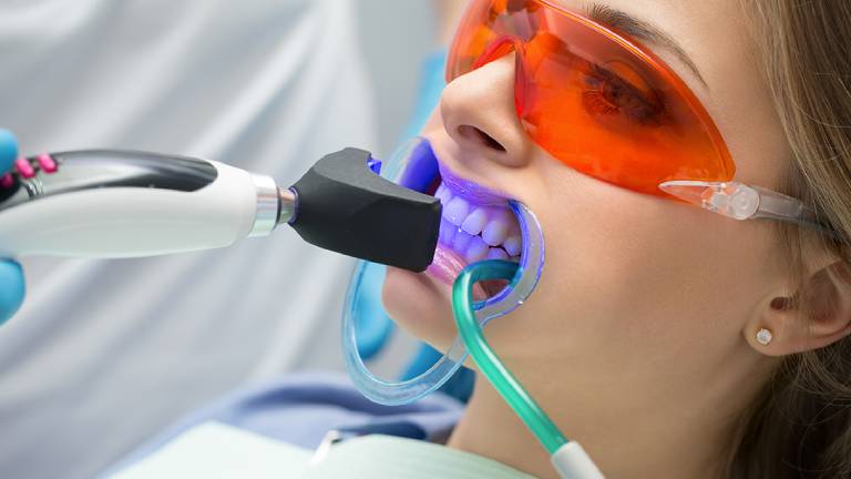 Teeth Whitening
